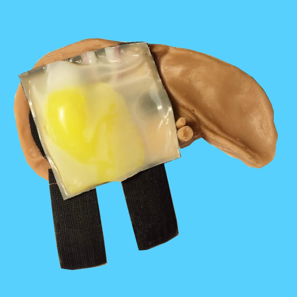 מודל האימון שפותח מאפשר סימולציה ריאליסטית של כל שלבי הניתוח הלפרוסקופי להסרת כיס המרה.